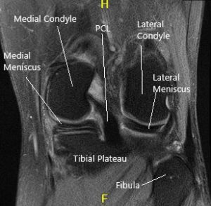 MRI of the knee in sagittal and coronal sections