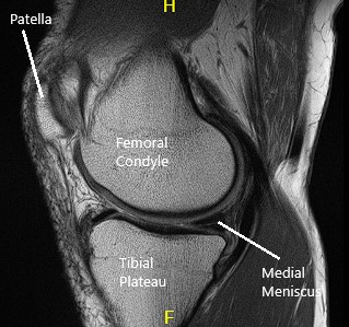 MRI of the knee in sagittal and coronal sections 2