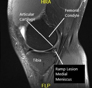 MRI of the knee in the sagittal and coronal section