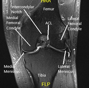 MRI of the knee in the sagittal and coronal section 2