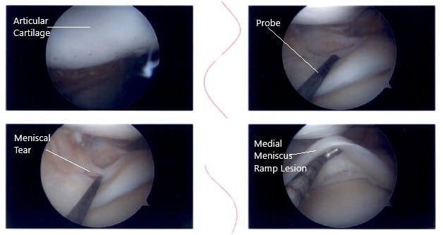 Intraoperative knee arthroscopic images