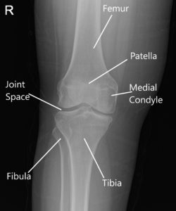 La resonancia magnética de la rodilla derecha sugirió desgarro del menisco medial y artritis patelofemoral de la rodilla derecha