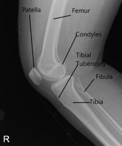 MRI of the right knee suggested medial meniscus tear and patellofemoral arthritis of the right knee 2