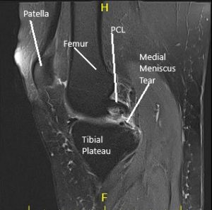 MRI of the right knee suggested medial meniscus tear and patellofemoral arthritis of the right knee 3
