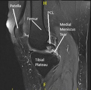 La resonancia magnética de la rodilla derecha sugirió desgarro del menisco medial y artritis patelofemoral de la rodilla derecha 3