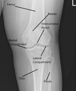 Radiografía de la rodilla izquierda que muestra AP y vistas laterales