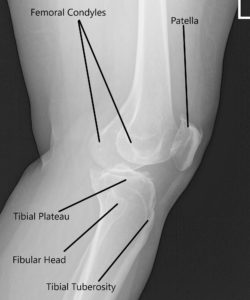 Radiografía de la rodilla izquierda que muestra AP y vistas laterales 2