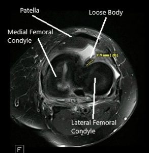 Resonancia magnética de la rodilla izquierda que muestra secciones axiales y coronales