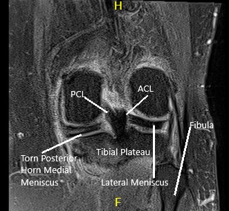 MRI of the left knee showing axial and coronal sections 2