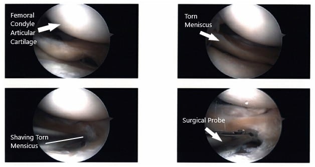 Intraoperative Arthroscopic images of the left knee 2