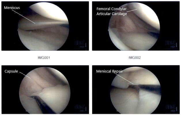 Intraoperative Arthroscopic Images of the right knee