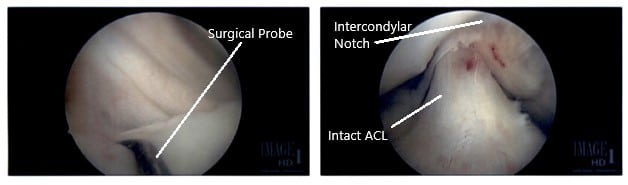 Intraoperative Arthroscopic Images of the right knee