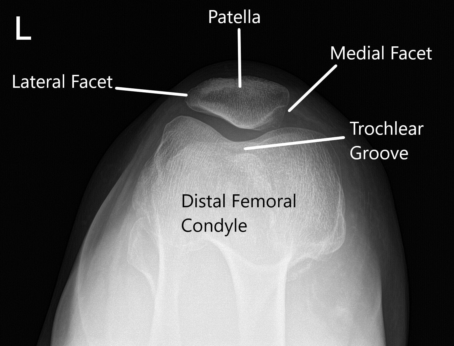 X-ray of the left knee in AP and skyline view of the patella 2