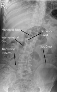 LS Spine X-ray in AP and Lateral views