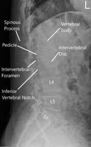 LS Spine X-ray in AP and Lateral views 2
