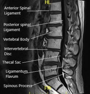 MRI of LS spine in sagittal and axial sections