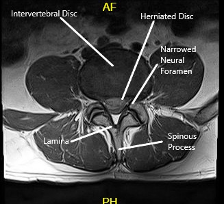 MRI of LS spine in sagittal and axial sections 2