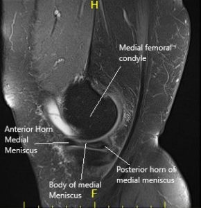 MRI of the left knee in sagittal and coronal sections