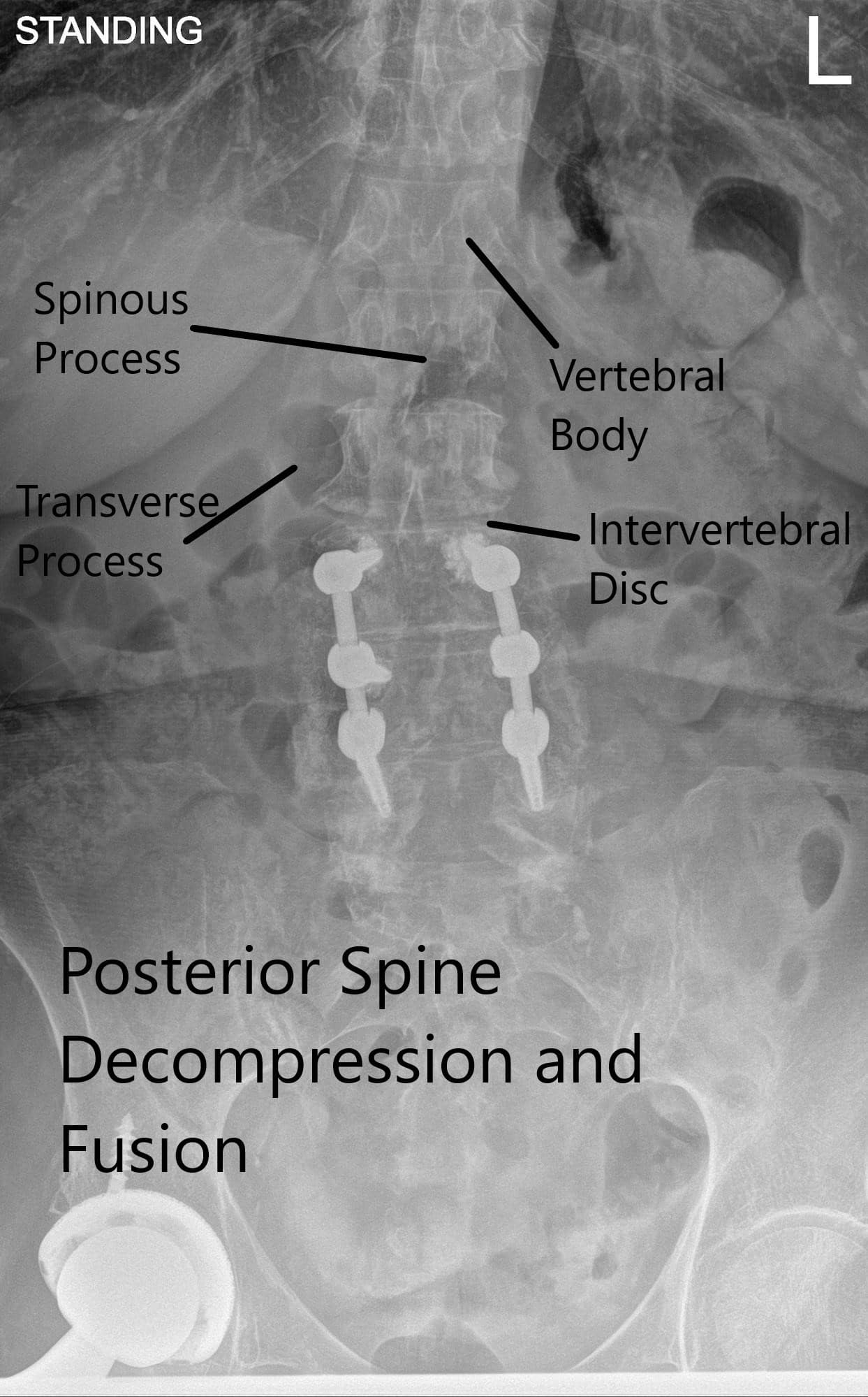 X-ray of the LS spine in AP and Lateral views