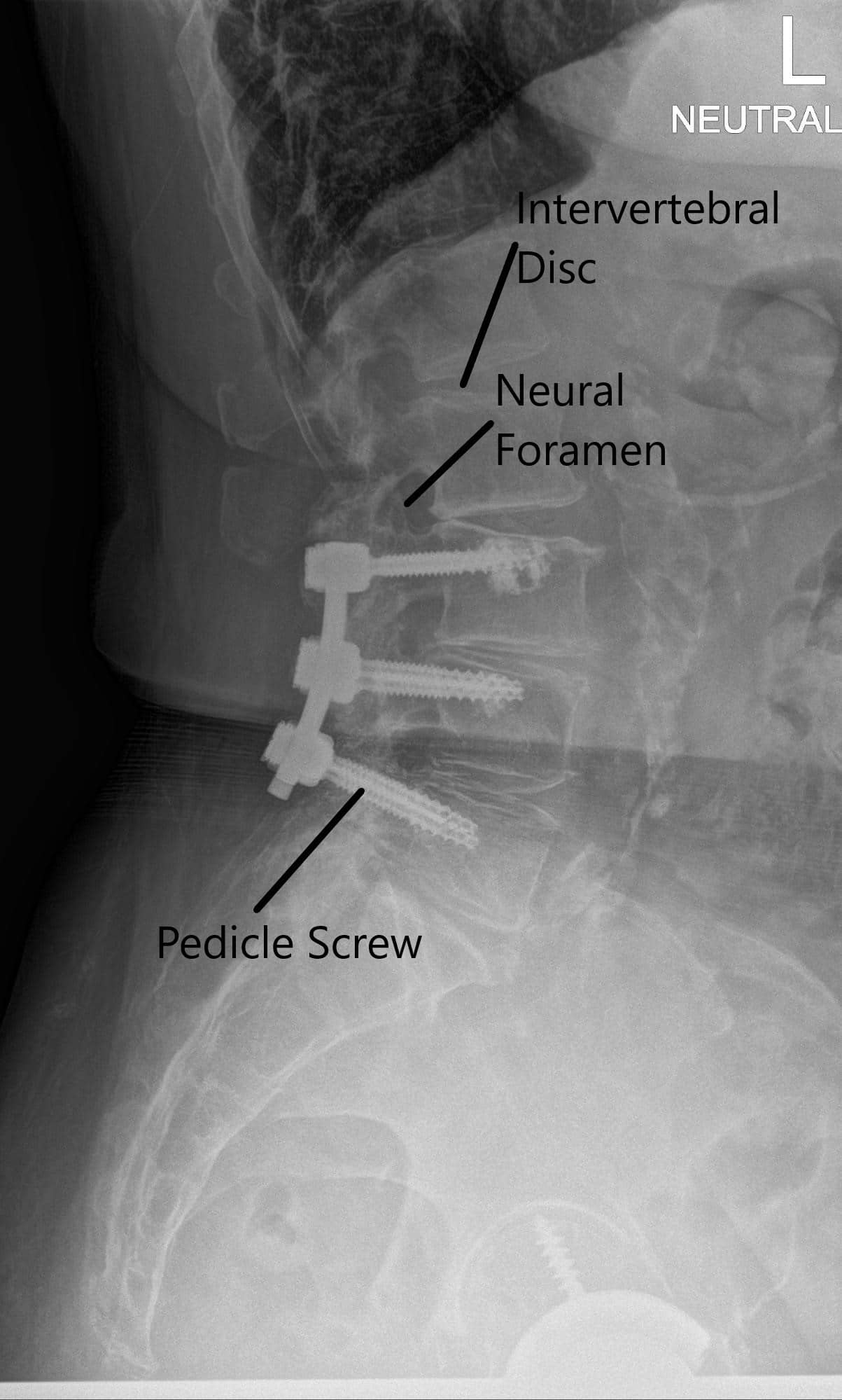 X-ray of the LS spine in AP and Lateral views 2