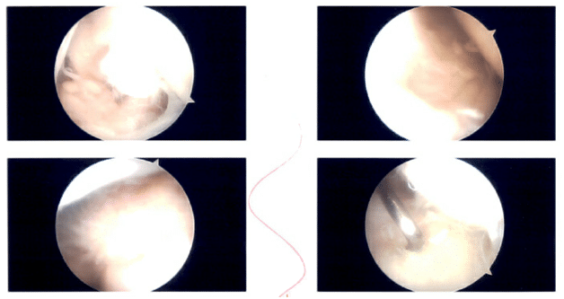 Intraoperative Shoulder Arthroscopic Images