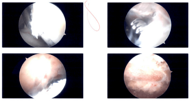Intraoperative Shoulder Arthroscopic Images 2