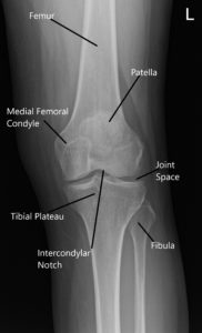 Radiografía normal de la articulación de la rodilla que muestra las diversas estructuras en la vista anteroposterior y lateral