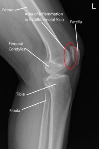 Radiografía normal de la articulación de la rodilla que muestra las diversas estructuras en la vista anteroposterior y lateral 2