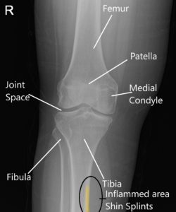 X-ray of a normal knee showing the area of inflammation in shin splints