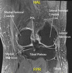 cirkulation God følelse orange Snapping Knee - Causes Management - Complete Orthopedics