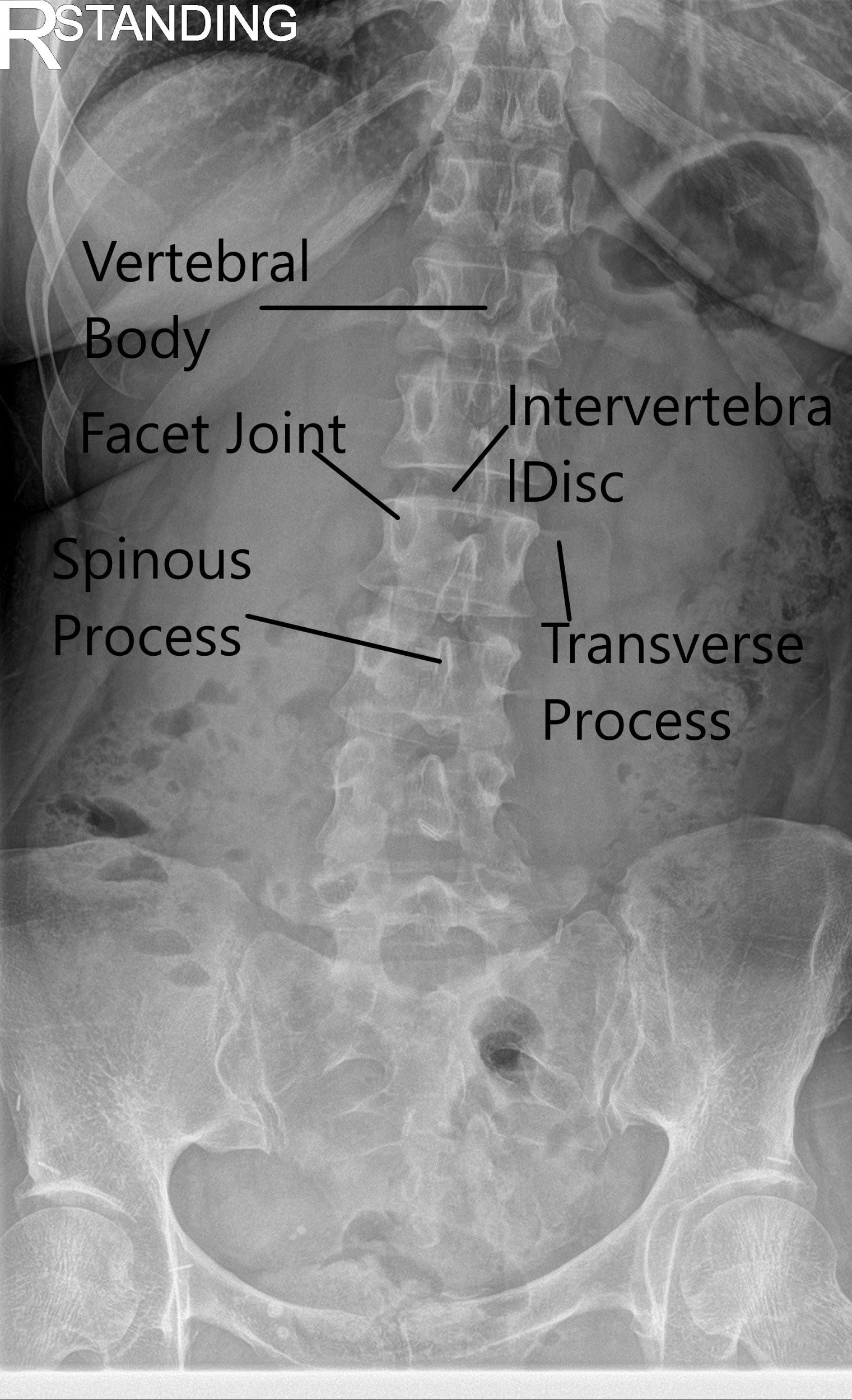 Radiografía de la columna vertebral LS en AP y vistas laterales que muestran cambios degenerativos
