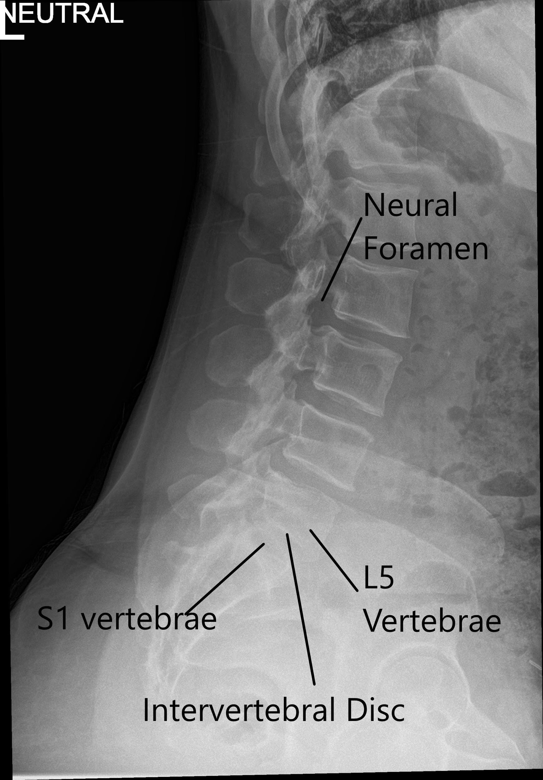 Radiografía de la columna LS en AP y vistas laterales que muestran cambios degenerativos 2