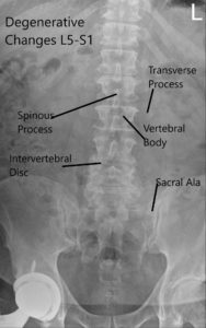 Radiografía preoperatoria LS columna vertebral en AP y vistas laterales