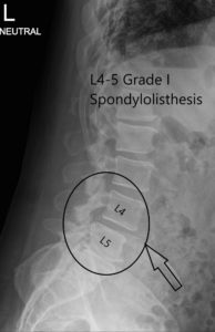 Radiografía preoperatoria LS columna vertebral en AP y vistas laterales 2