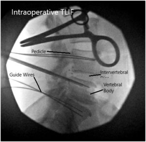 Imágenes fluoroscópicas intraoperatorias