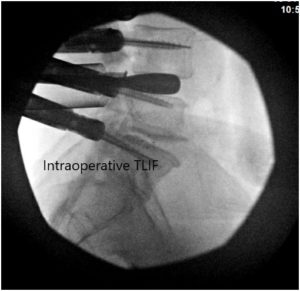 Imágenes fluoroscópicas intraoperatorias 2