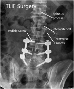 Postoperative X-ray in AP and Lateral views