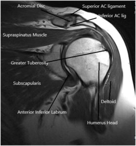 MRI of the shoulder joint