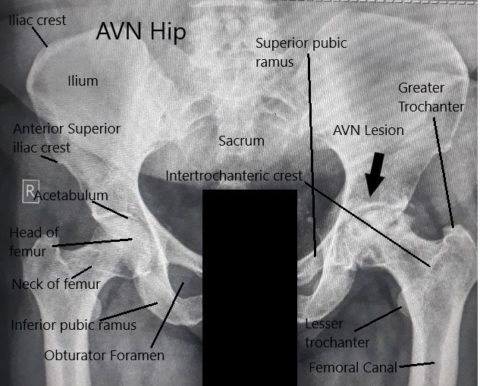 Alcohol Intake Avascular Necrosis Of The Hip Complete Orthopedics