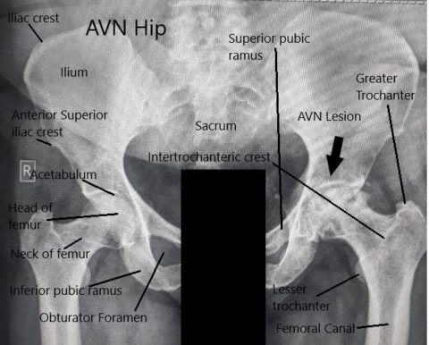 Alcohol Intake Avascular Necrosis Of The Hip Complete Orthopedics alcohol-intake-avascular-necrosis-of-the-hip-complete-orthopedics