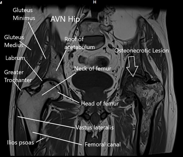 Resonancia magnética de ambas articulaciones de la cadera en la sección coronal