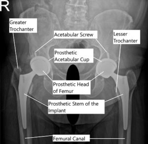 Intimacy after Total Hip Pain & Replacement | Complete Orthopedics