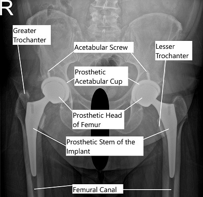 Radiografía que muestra reemplazo total bilateral de cadera