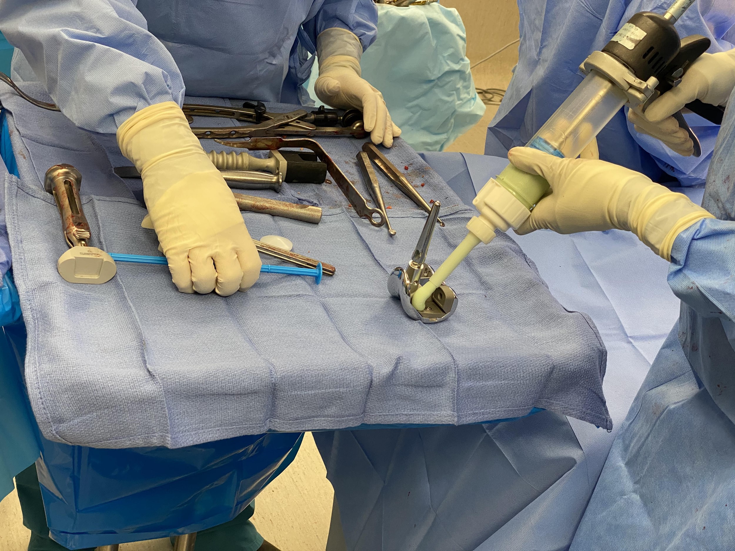 Cementing of the femoral component