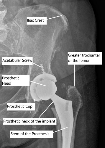 X-ray showing robotic assisted total hip replacement.