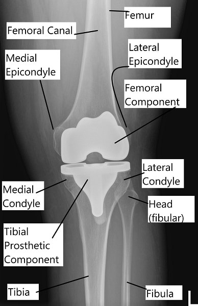 Total knee replacement X-ray