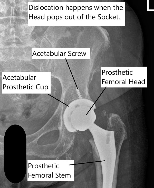 Total Hip Arthroplasty dislocation