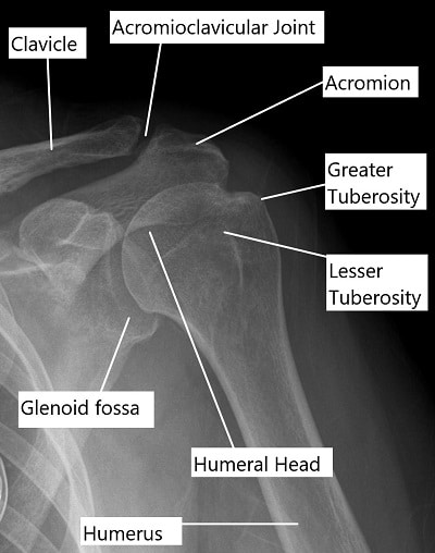 X-ray of the shoulder joint.