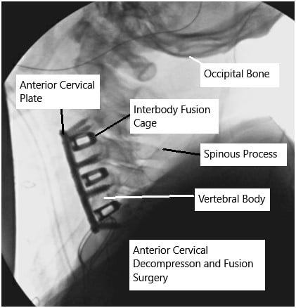 Intra-operative fluoroscopy image showing anterior cervical decompression and fusion.