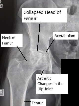 Radiografía que muestra necrosis avascular de la articulación de la cadera. Radiografía que muestra necrosis avascular de la articulación de la cadera
